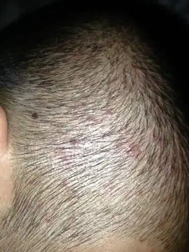 头皮长红疙瘩.有点像粉刺那样.