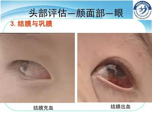 结膜与巩膜 结膜充血 结膜出血