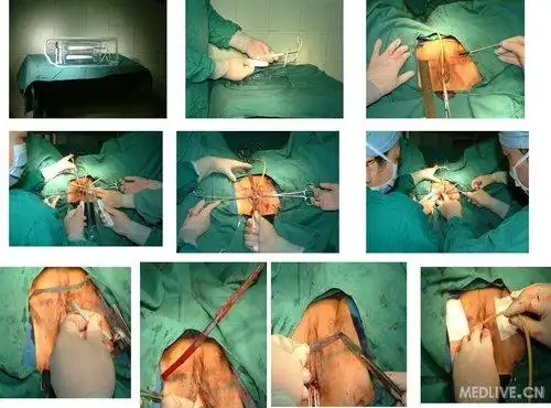 收了个压力性尿失禁的患者尝试了下tot手术