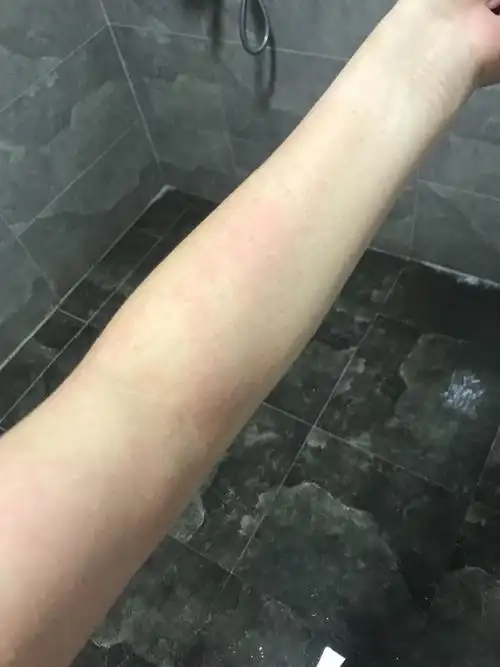 胳膊全身都是这样的红的,有时候还特别痒,是过敏吗