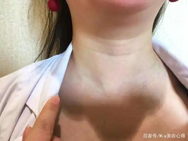 女人脖子出现"三条杠",你知道表示什么吗?别傻傻不在意