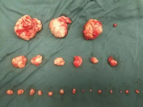 现实版"滚蛋吧肿瘤君",关于子宫肌瘤这些你知道吗?