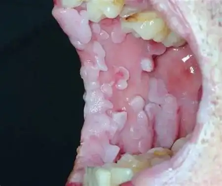 真实女性早期hpv感染图片(低危型各种寻常疣)