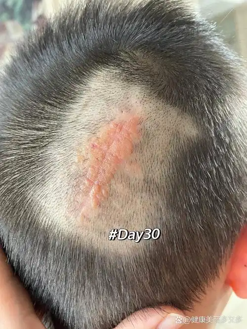 和皮脂腺痣说拜拜