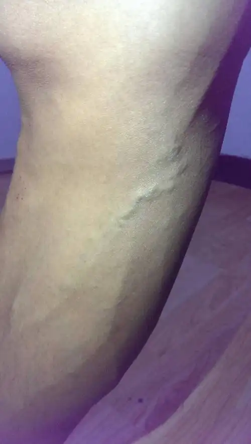 问:这样的静脉曲张算不算严重呢