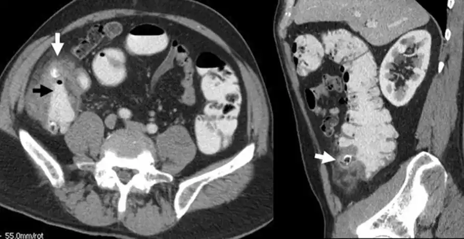 结肠憩室炎的ct真相:专家解读不寻常表现