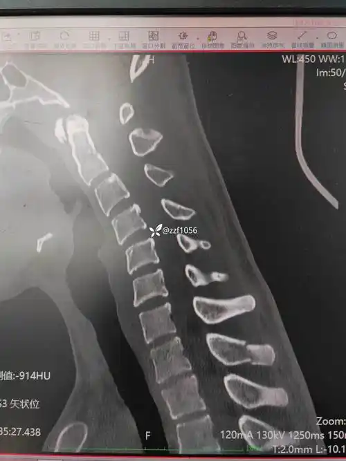 少见病例21岁铲沙工干活3天导致单纯棘突骨折怎么处置