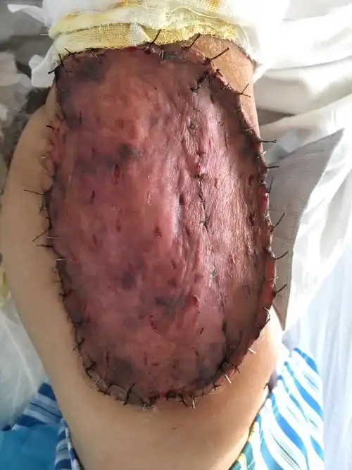 背部取皮,右上臂植皮术后1周,皮片成活良好.