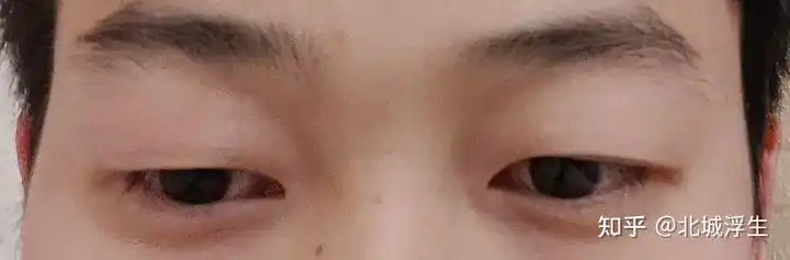 眼睛一高一低该怎么办?