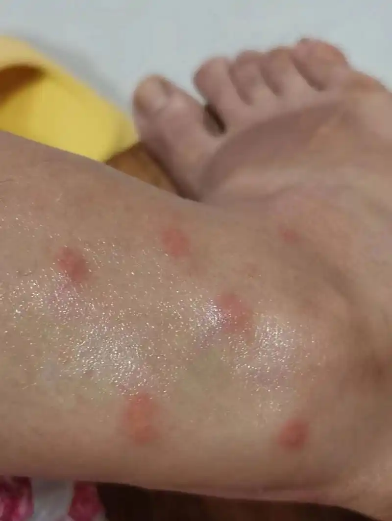 旅行中不知道被什么虫子咬了,又痒又肿医生盆友建议