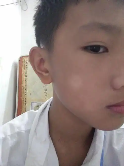 儿童白斑易混淆,给孩子做专业检测方可确诊白癜风