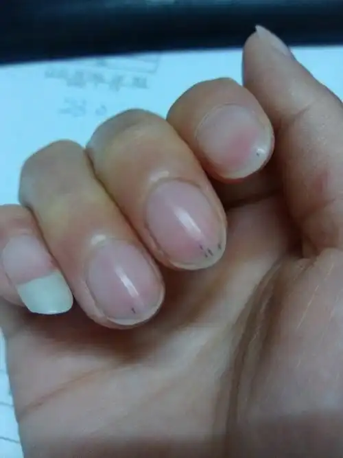 手指甲上有黑点是什么原因?如图～ 请专业人士回答,感谢!