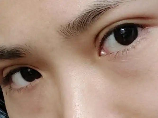 埋线双眼皮,第三天这样正常吗?单独看两只眼睛好像有点不对称