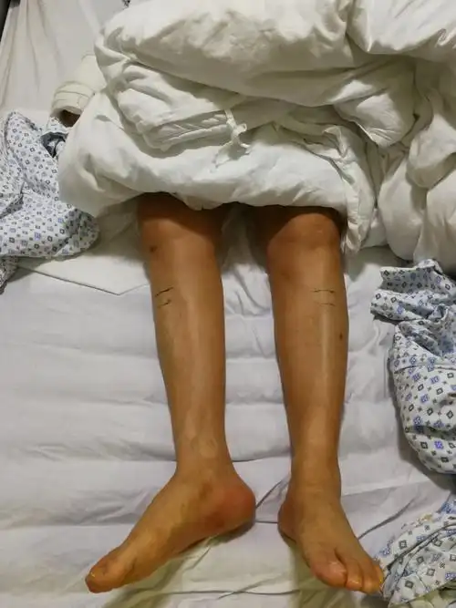 三高〃合并〃股骨颈骨折〃的手术治疗_患者