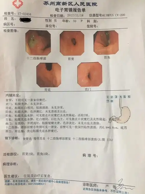 (2)胃镜后说要病理检查,是否会是胃癌?