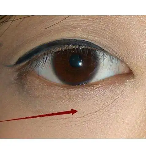 怎样阻止脸上的干纹细纹变成永久性的皱纹?