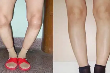 【图】o型腿危害有很多 这几个尤其严重