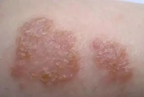 浅谈核医学科同位素敷贴治疗慢性湿疹顽疾_湿疹_介绍_症状表现_治疗