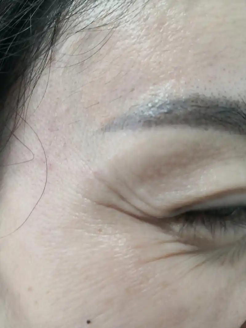 眼角纹明显.可以使用肉毒素注射除皱治疗.