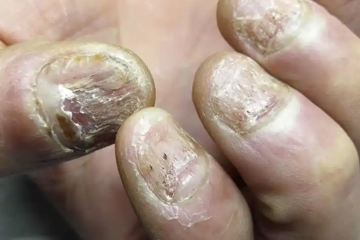 糖尿病指甲病变图片