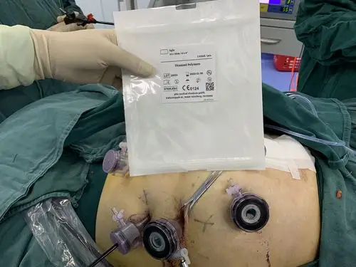 15*15cm pfm补片作第二层修补,价格7790,sugarbaker术式.