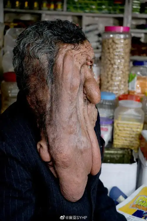 印度男子患上神经纤维瘤