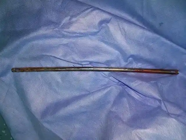 再小的疏漏,终将会作祟!一根25年前骨折后植入的钢钉,惹祸了