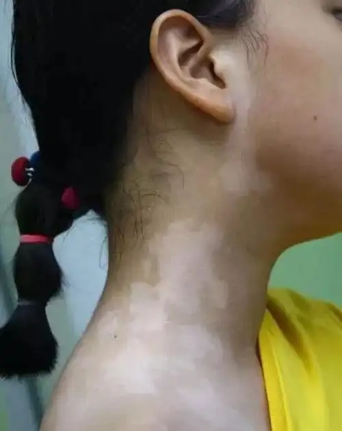 姐姐萱萱(化名)出生后几个月,额头处就有一块瓶盖大小的乳白色斑块.