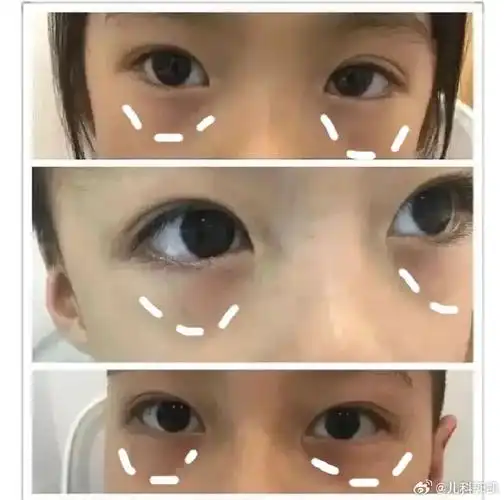 鼻梁上有青筋,刚开始没注意,以为是没睡好,后来孩子开始便秘,积食,不