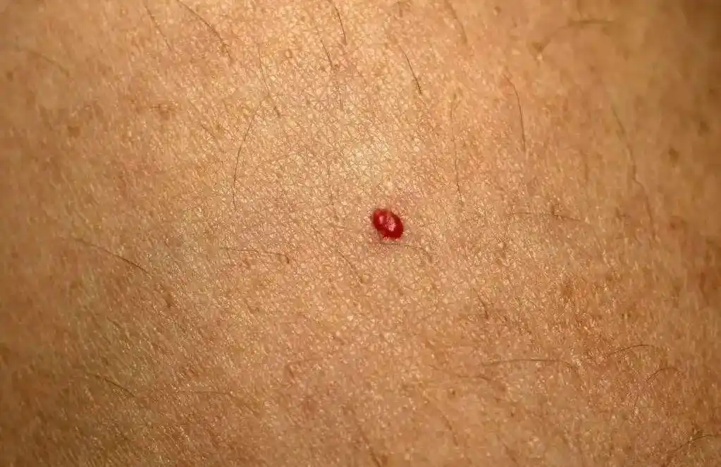 皮肤长了小红点,是怎么回事?专家:建议去医院做个肝部ct检查下