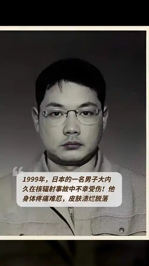 1999年,日本的一名男子大内久在核辐射事故中不幸受伤!