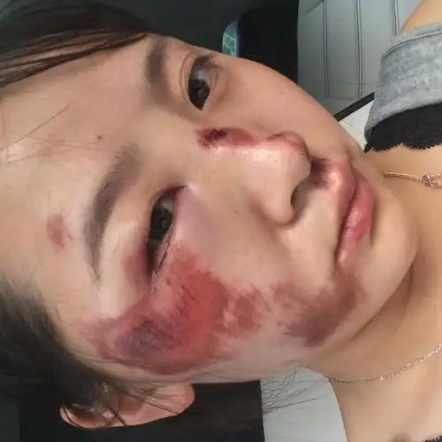 我脸上擦伤,眼睛肿的厉害,今天第二天,去医院消了毒,挂了消炎