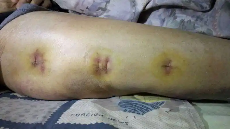 01.04),拆线后伤口甲级愈合.