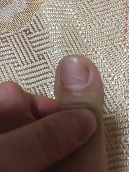 脚趾甲这是怎么了?