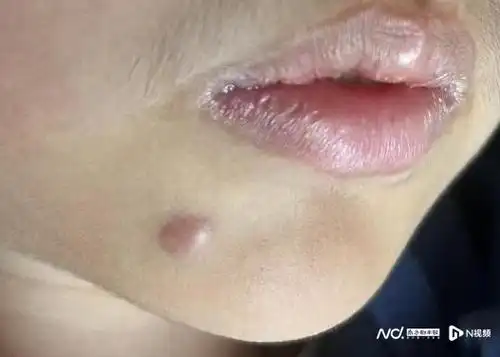 9岁孩子街边点痣致瘢痕增生,医生提醒:激光祛痣更安全