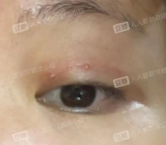 有没有朋友眼皮上有小白点的09