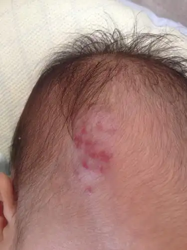 问:宝宝头上长个血管瘤该怎么治疗宝宝才2个月大