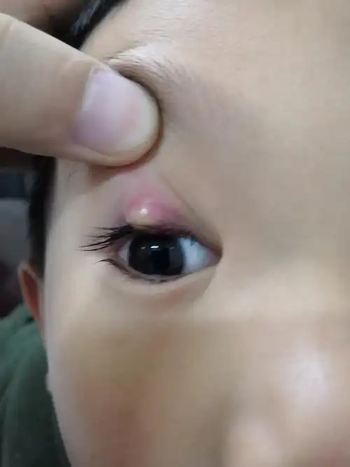 睑腺炎(俗称:麦粒肿,中医名:针眼)的个人经验治疗_麦粒肿 - 好大夫