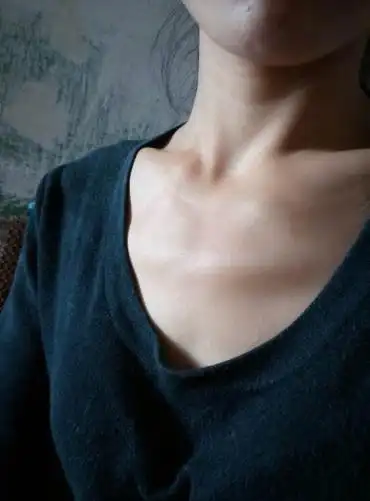 女孩胸骨前突:手术?不手术?