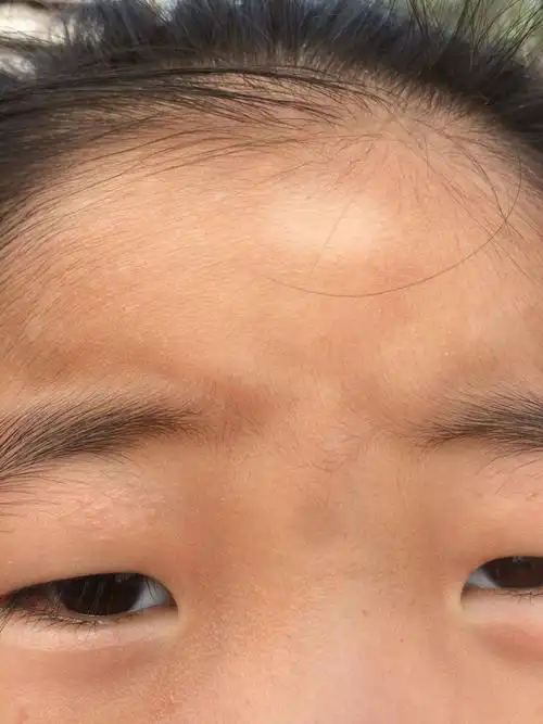 女儿脸上为什么会有一块一块的白 没有磕着 碰到 最近自然有的