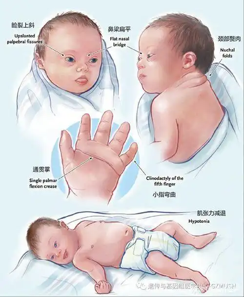 产科开展"世界唐氏综合征日"主题宣传活动