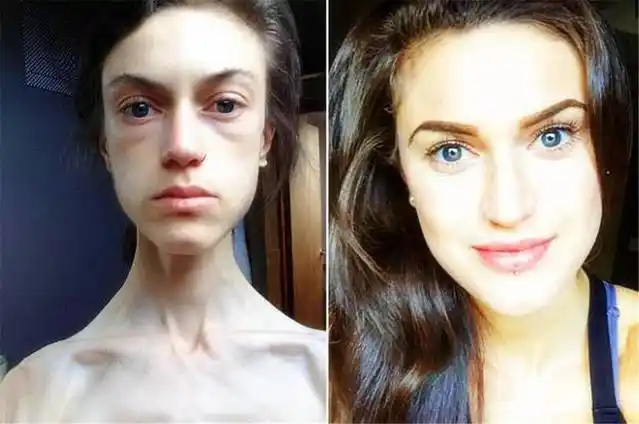 15岁适合减肥吗 女15岁是否合适减肥