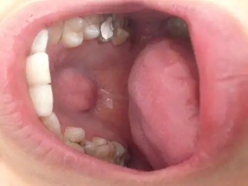 最近补牙时医生说我上颚和别人不一样我才知道,一直以为它就是这样的