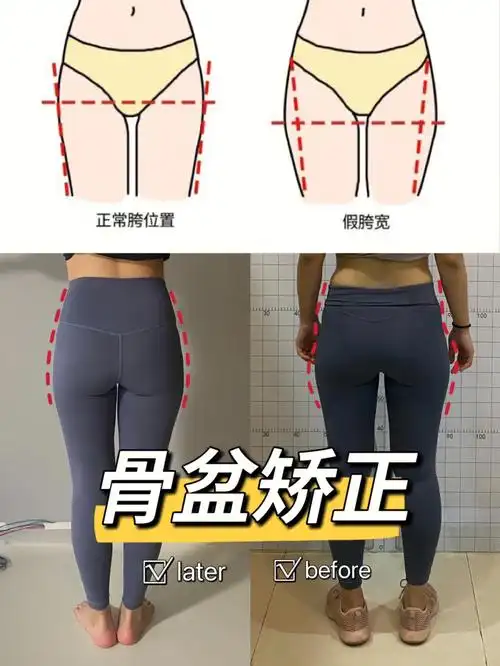 福州产康私教骨盆矫正75假胯宽梨型直腿