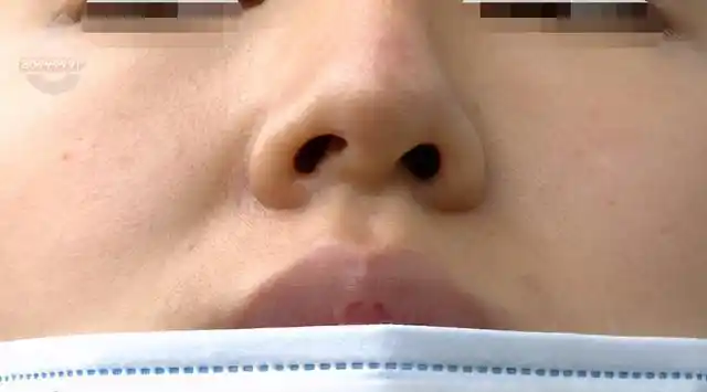 小何:"鼻小柱歪斜,倒塌,导致我不能呼吸,常年都是靠嘴巴呼吸的