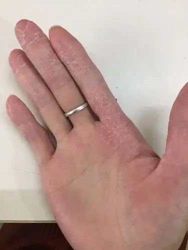 手指有皮肤病到现在6年多时间手指处会干裂会瘙痒饶痒之