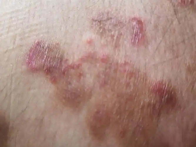 屁股上的,反反复复.好了没多久又反复.