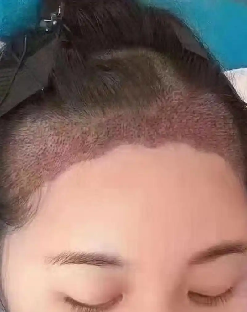 美人尖发际线好不好?