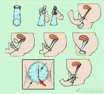 避孕套妇炎康等药打假