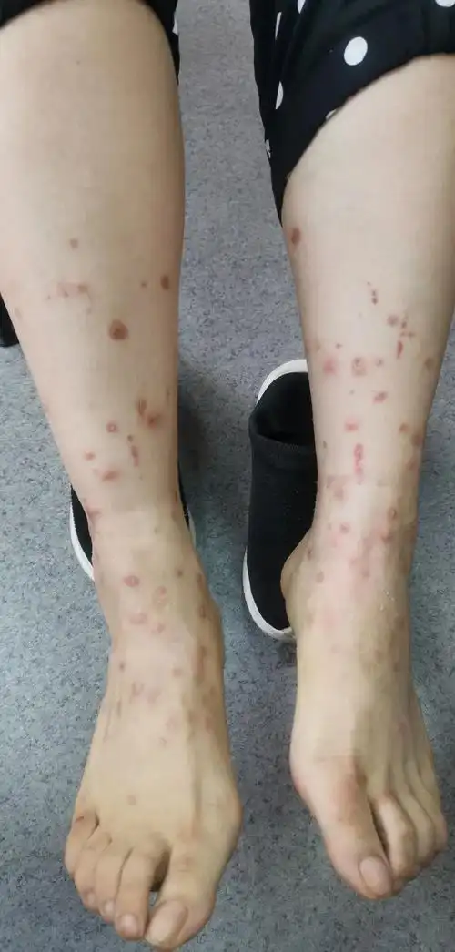 夏季虫类猖獗来了解如何应对虫咬皮炎吧